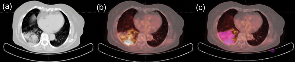 Machine learning approach using 18F-FDG PET-based radiomics in differentiation of lung adenocarcinoma with bronchoalveolar distribution and infection