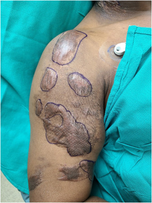 Burn Scar Management and Reconstructive Surgery