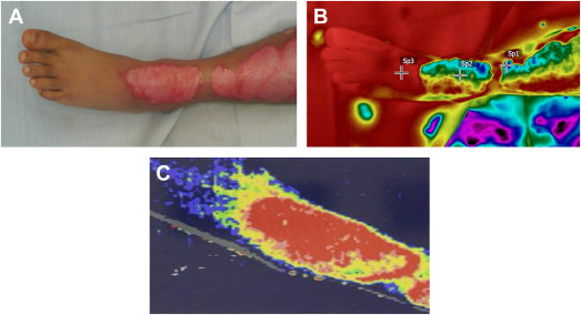 Outpatient and Minor Burn Treatment