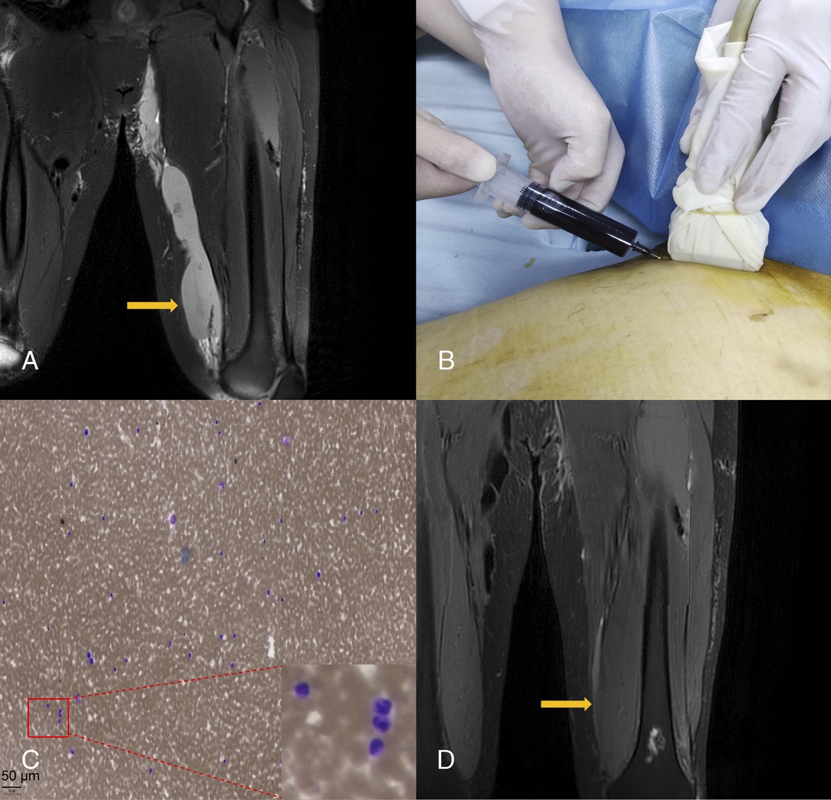 Relapsing Hematoma Secondary to Anti-MDA5 Dermatomyositis