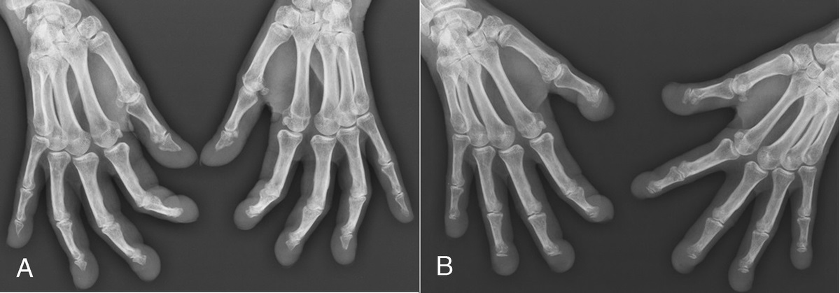 Progressive Acro-Osteolysis