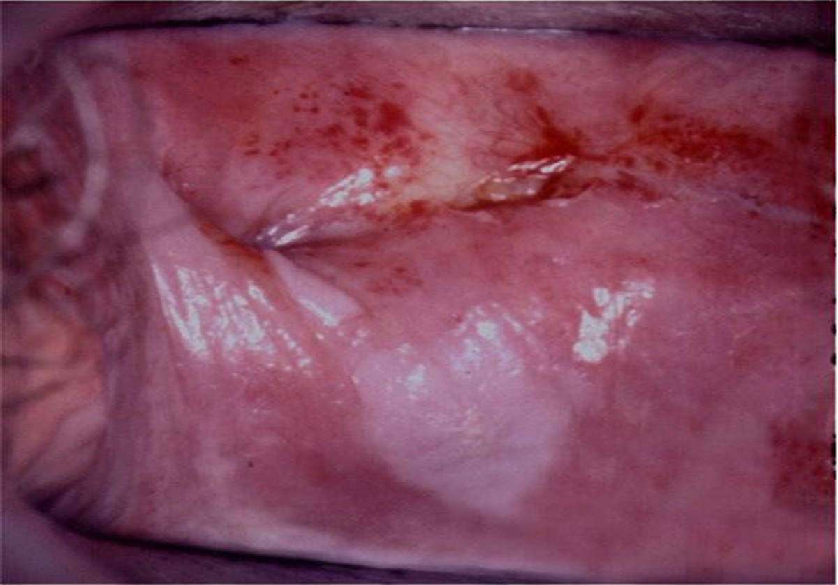 The European Society of Gynaecological Oncology (ESGO), the International Society for the Study of Vulvovaginal Disease (ISSVD), the European College for the Study of Vulval Disease (ECSVD), and the European Federation for Colposcopy (EFC) Consensus Statement on the Management of Vaginal Intraepithelial Neoplasia