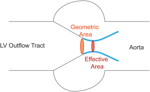 Aortic Valvular Stenosis and Heart Failure