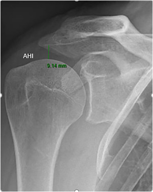 Modifiable and Nonmodifiable Risk Factors Associated with the Development of Recurrent Rotator Cuff Tears