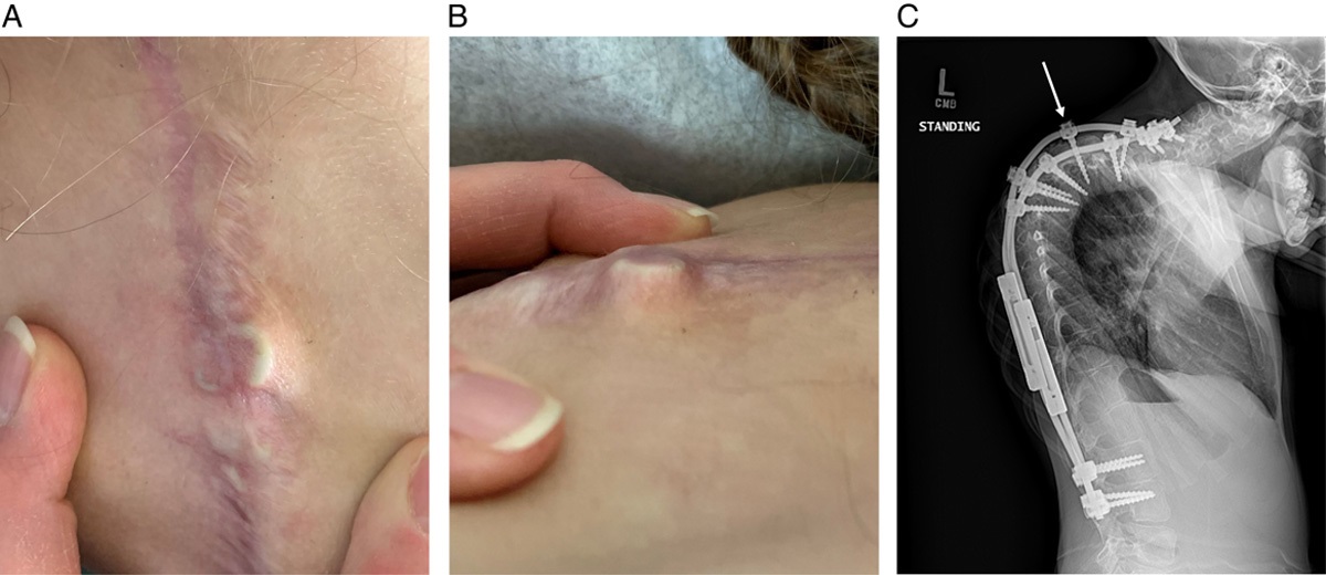 Cement Capping of Prominent Spinal Implants to Prevent Skin Breakdown