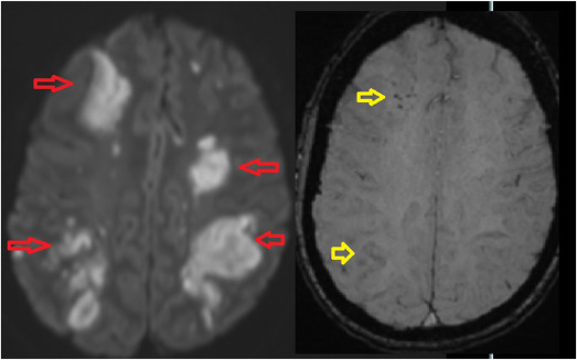 Gender Differences in Intracerebral Hemorrhage