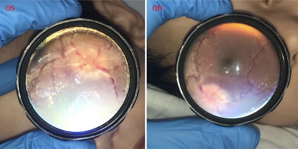 A Child With Arthralgia and Bilateral Vision Loss