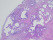 Hypersensitivity Pneumonitis