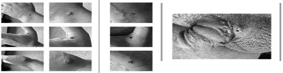 Mpox Masquerading as Secondary Syphilis
