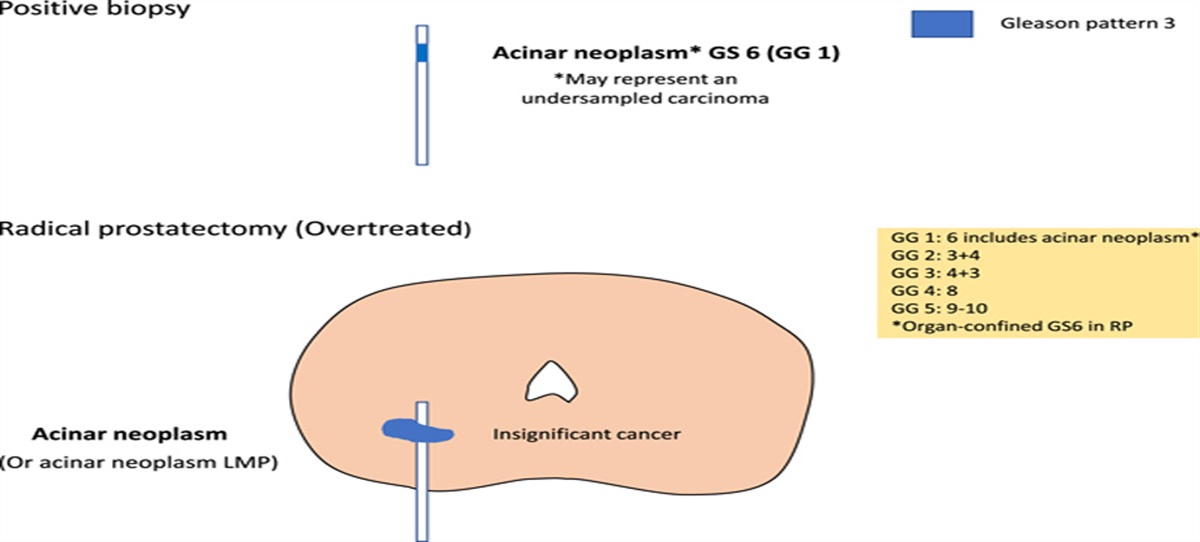 Renaming Grade Group 1 Prostate “Cancer” From a Pathology Perspective: A Call for Multidisciplinary Discussion