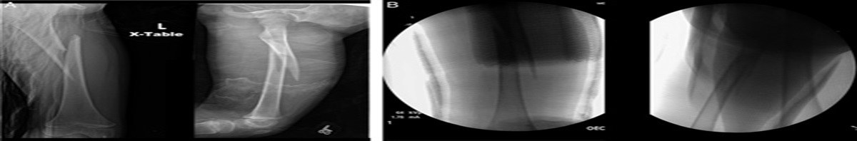 Open Reduction of Pediatric Femur Fracture: A Technical Trick