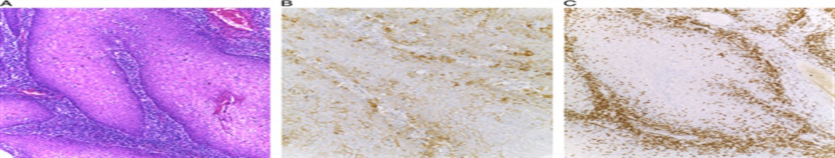 Role of Surgical Pathologist for Detection of Immunooncologic Predictive Factors in Head and Neck Cancer