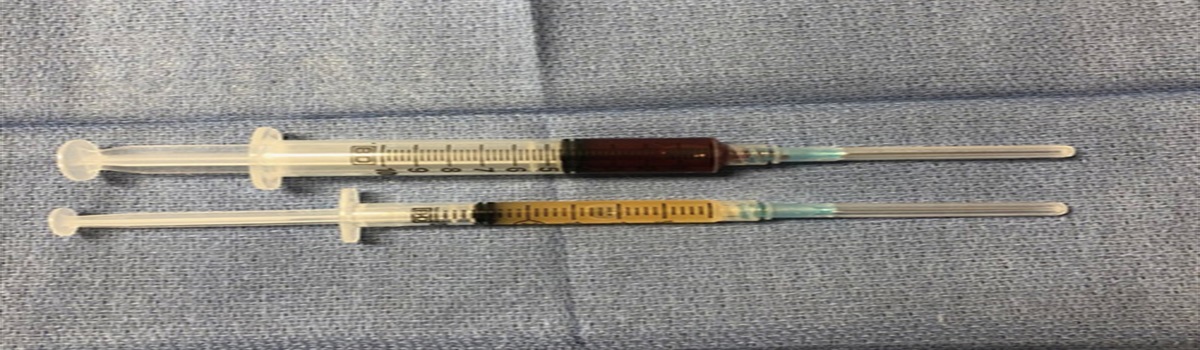 Creating 2 Unique Platelet-rich Plasma Products From a Single Batch of Whole Blood With a Single Processing Kit