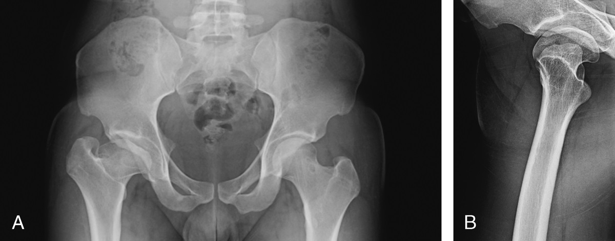 The Mushroom Femoral Head in Legg-Calvé-Perthes Disease