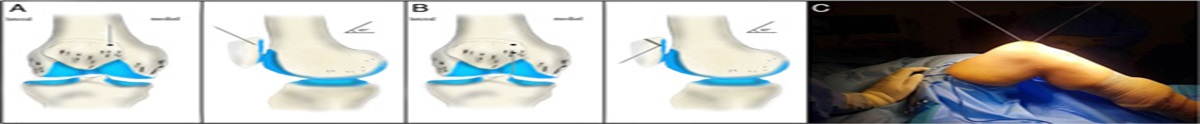 A Novel Technique for Medial Patellofemoral Ligament Reconstruction Using Vertical Patellar Tunnels and Use of a Single Implant. Technical Note