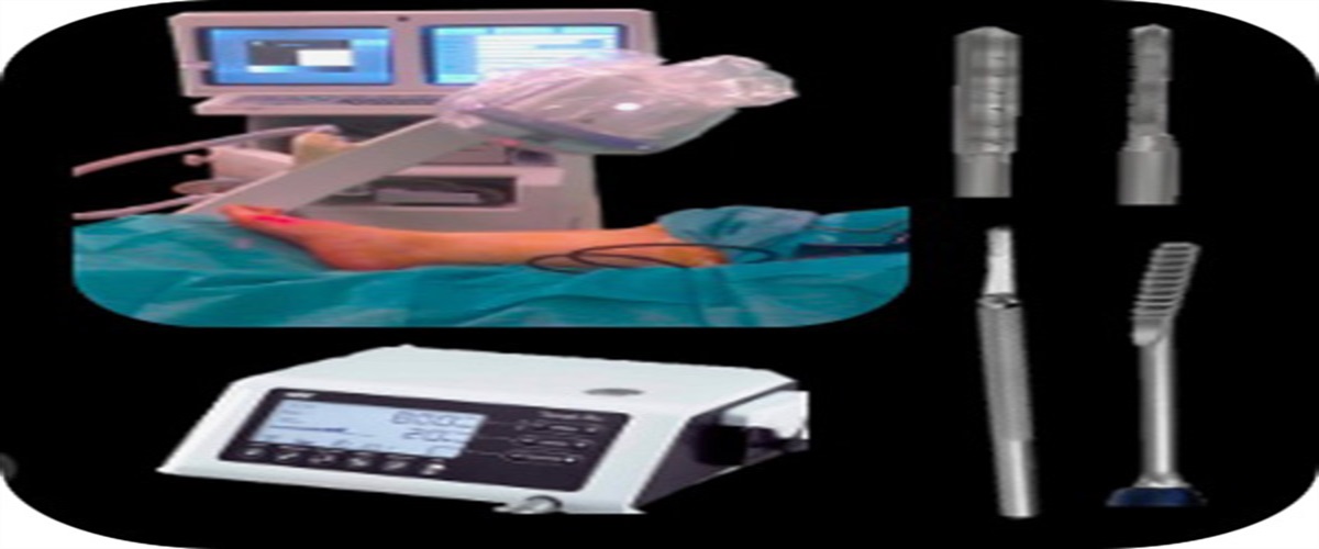 Third Generation Rotational Percutaneous Osteotomy to Hallux Valgus