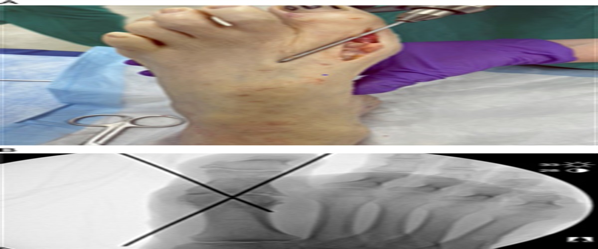 Cross Screw Fixation for First Metatarsophalangeal Joint Arthrodesis: A Technical Guide