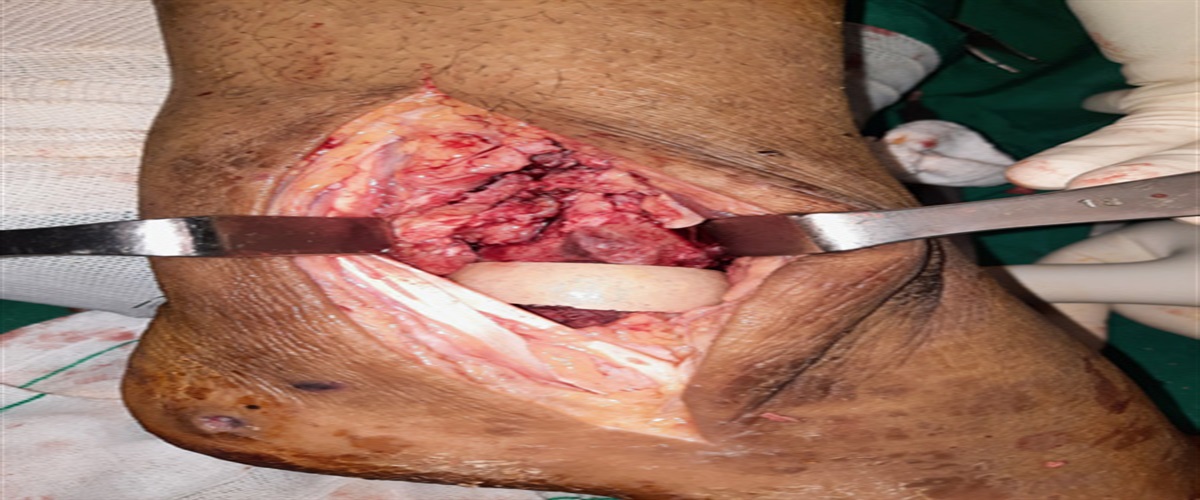 Fibular Strut Autograft as an Augmented Biological Plate: A New Modified Technique for Tibiocalcaneal Arthrodesis With Intramedullary Nail