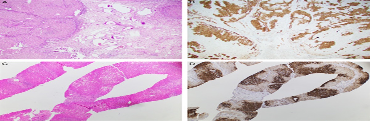 Pathologic Diagnosis of Well-differentiated Hepatocellular Lesions: A Practical Approach to Diagnosis With Particular Focus in Core Needle Biopsies and Utilization of Ancillary Techniques