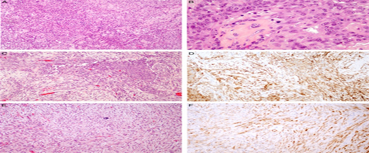 Mesotheliomas in Children