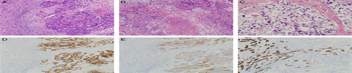 Secondary Tumors of the Kidney: A Comprehensive Clinicopathologic Analysis