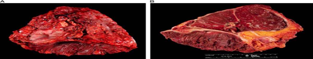 Pleural Mesothelioma: Current Practice and Approach