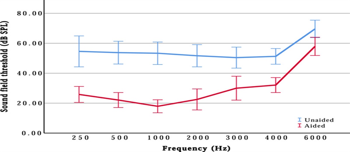 Long-term Outcome of Sound Localization with Baha® Attract System