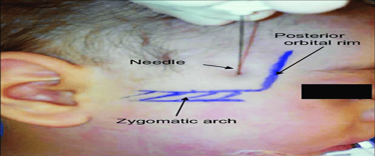 Utility of Regional Maxillary Nerve Blocks in Improving Cleft Palate Postoperative Outcomes