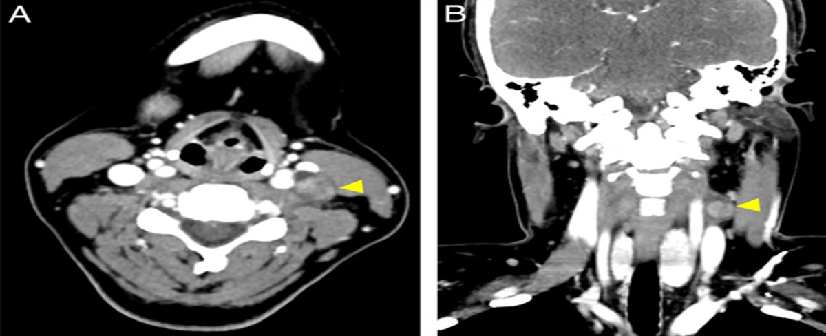 Application of Adhesive Skin Electrode for Intraoperative Neuromonitoring During Enucleation of a Cervical Vagal Schwannoma