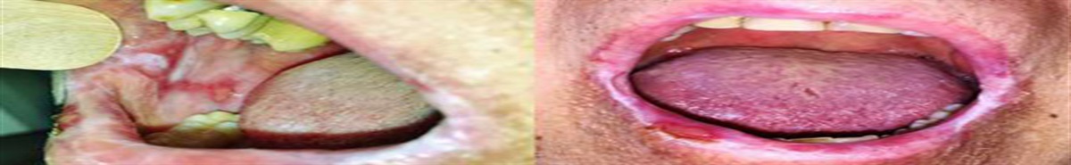 Treatment of Oral Mucositis Using Platelet-Rich-Fibrin: A Retrospective Study on Oncological Patients