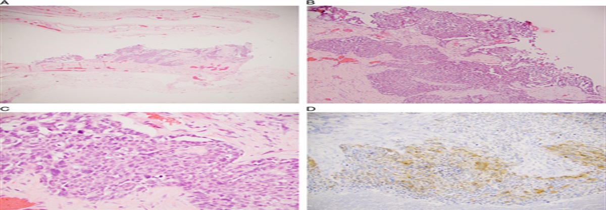 Malignant Mesothelioma of Tunica Vaginalis Testis: Update for 2022
