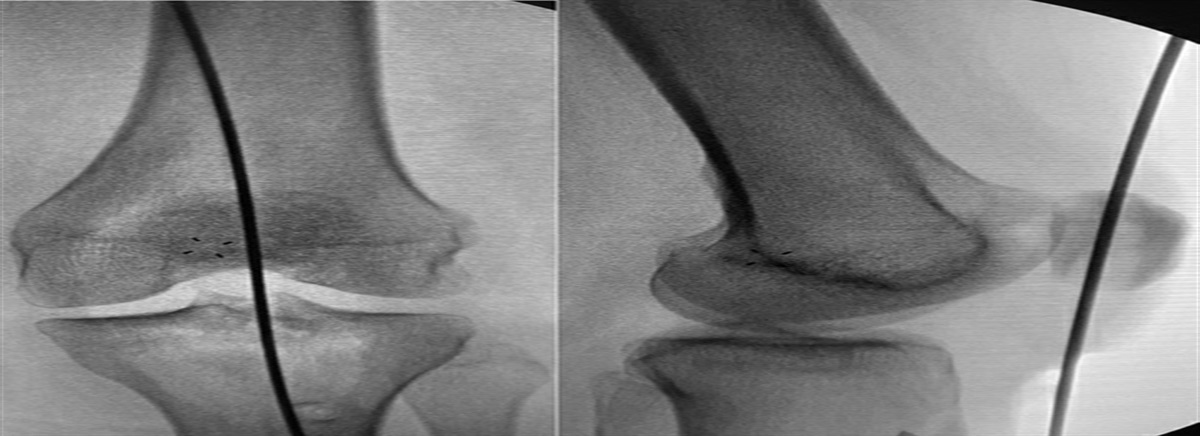 A Novel Patellar Tendon Reconstruction Technique Using Semitendinosus Allograft