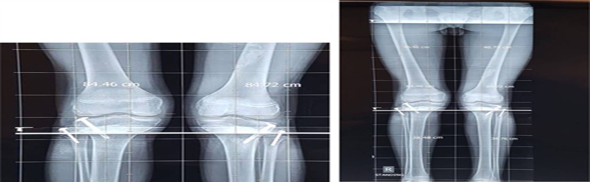 Supplementary Fibular-guided Growth in Treatment of Late-onset Blount Disease