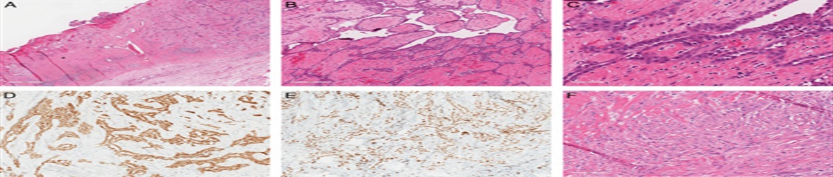 Pericardial Mesotheliomas
