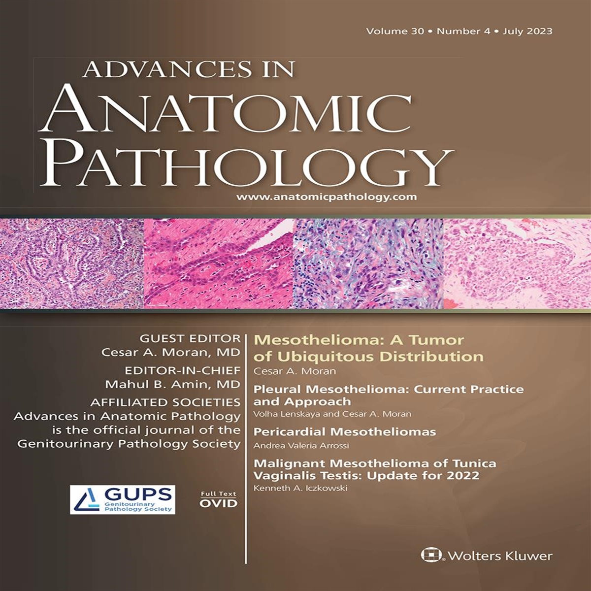 Mesothelioma: A Tumor of Ubiquitous Distribution