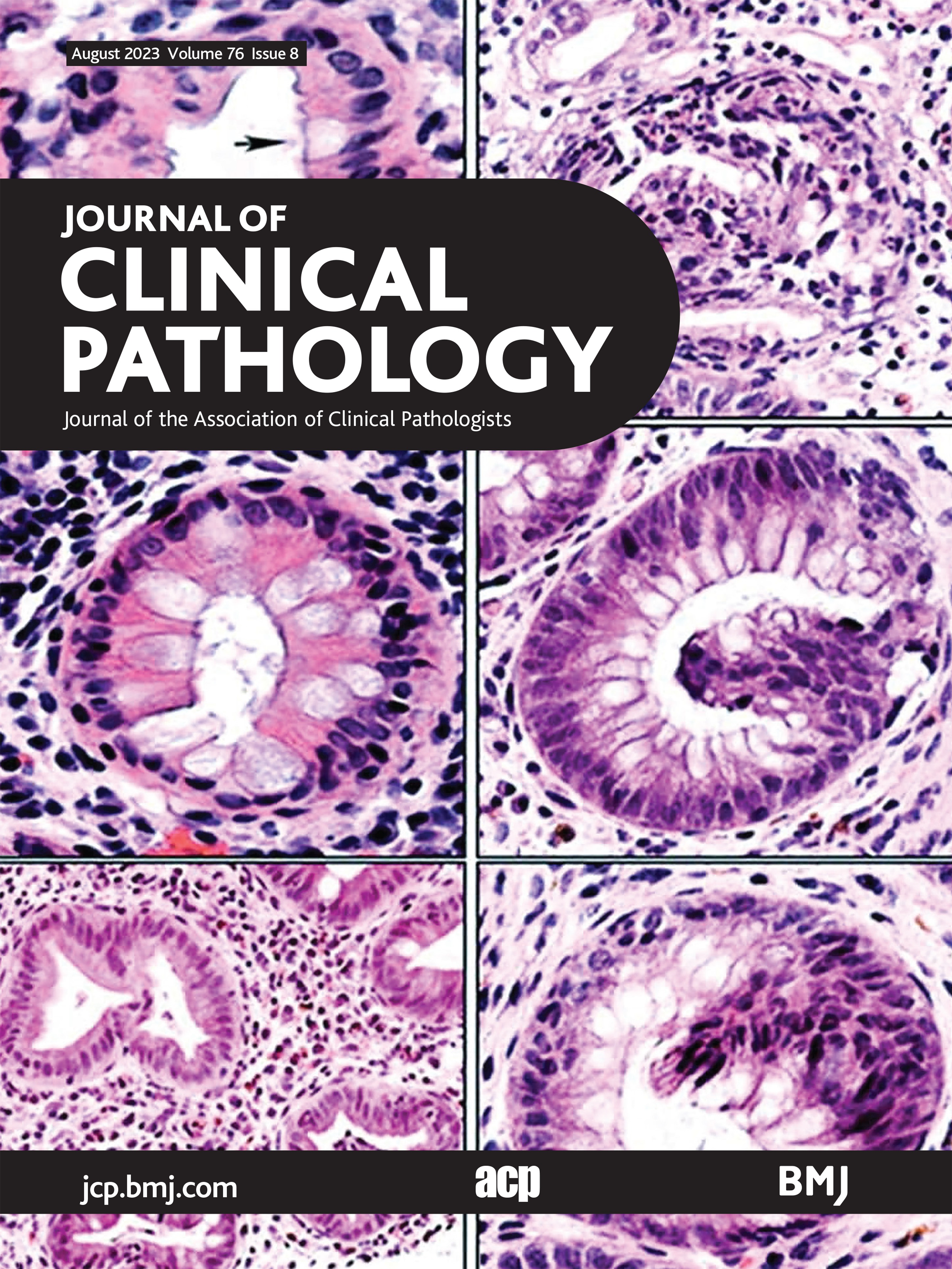 Neuroblastoma-derived v-myc avian myelocytomatosis viral related oncogene or MYCN gene