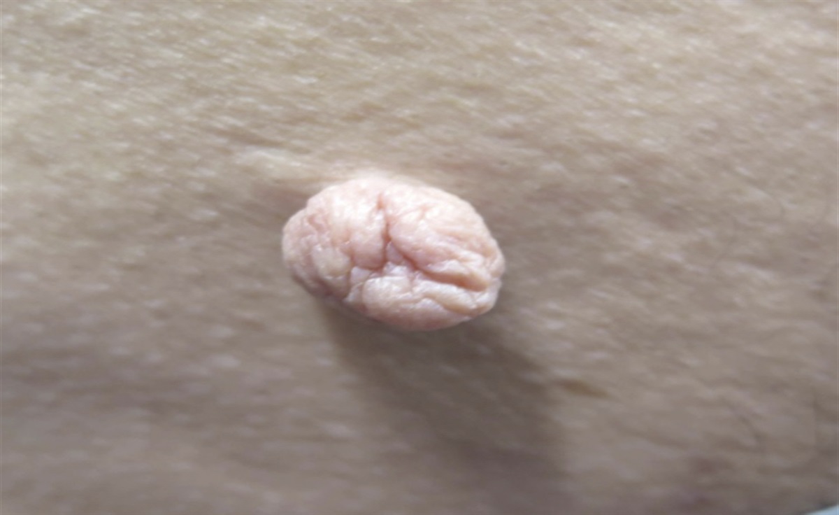 Large Pedunculated Papule on the Left Axilla