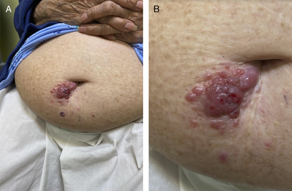 Sister Mary Joseph's Nodules: A Sign of Greater Cancer Burden