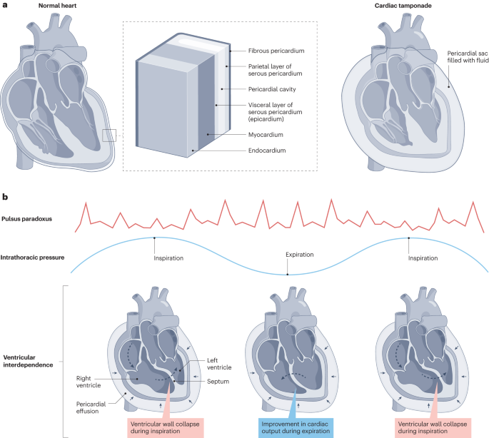 Cardiac tamponade