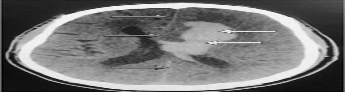Intracranial Hemorrhage Presenting With ST-Segment Elevation and T-Wave Inversion Concerning for Acute Myocardial Infarction