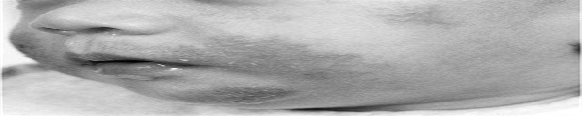 Atopic Dermatitis: A Common Pediatric Diagnosis That Is Not Just Another Rash