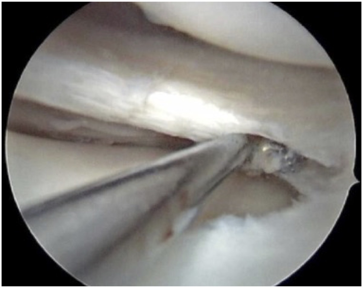 Horizontal Cleavage Meniscus Tears: Biomechanics, Indications, Techniques, and Outcomes