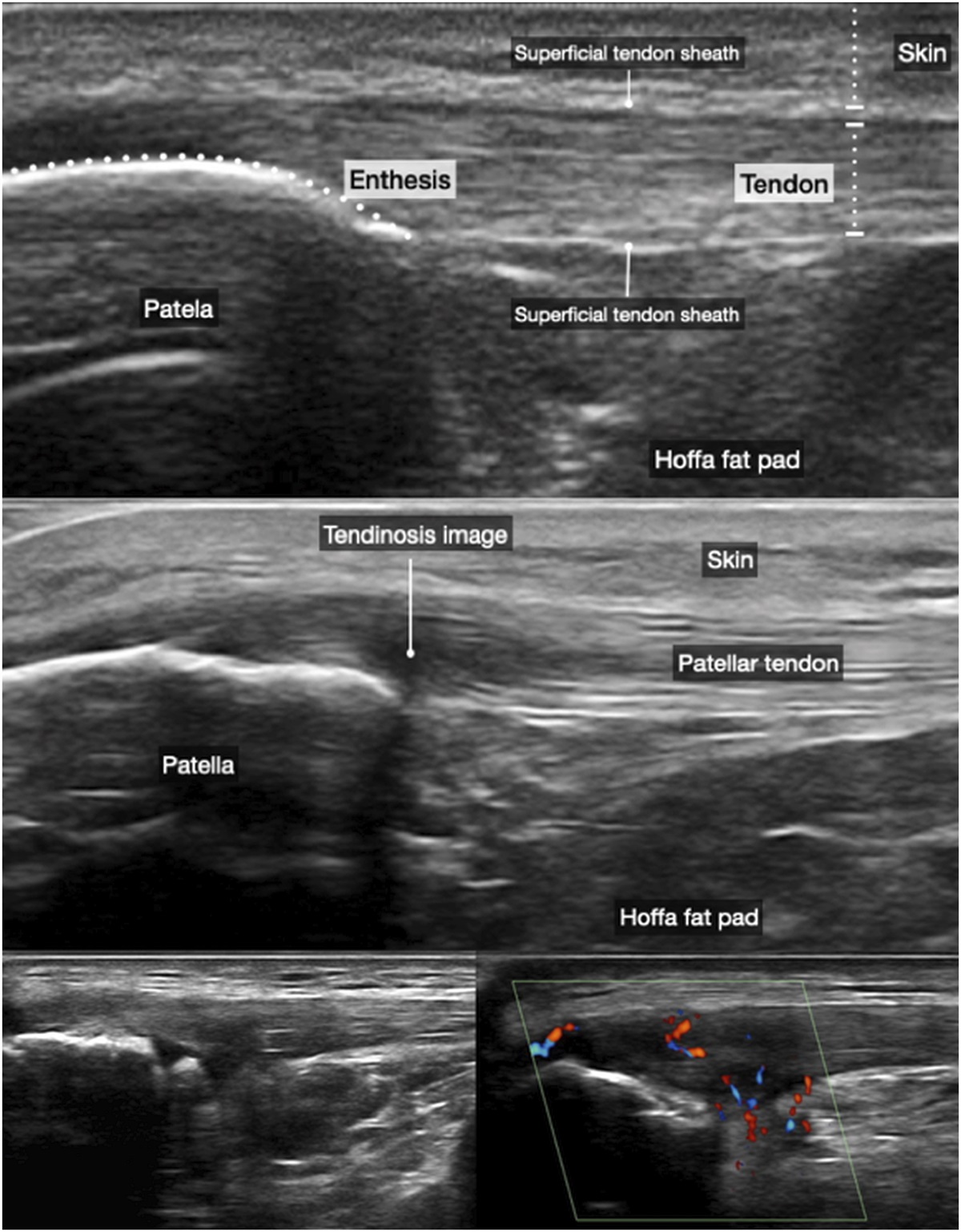 Current Concepts in Patellar Tendinopathy: An Overview of Imaging, Pathogenesis, and Nonoperative and Operative Management