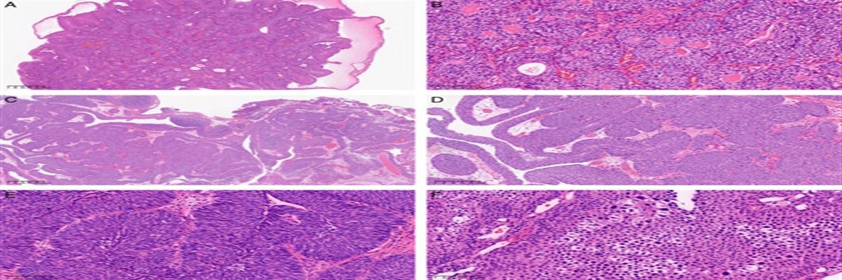 Clinicopathologic Features of Noninvasive Inverted Urothelial Papillary Tumor