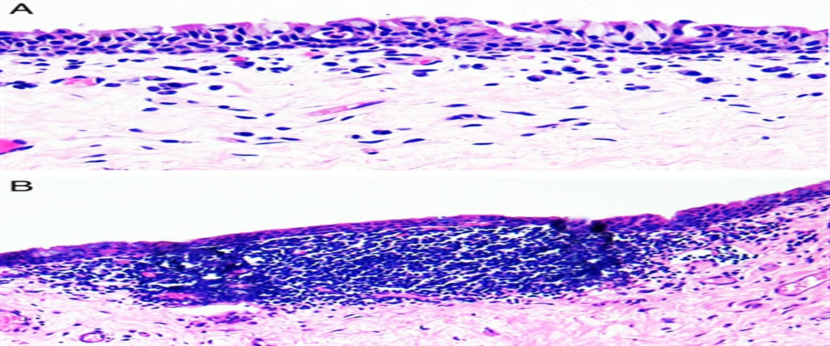 Conjunctivitis: A Primer on Conjunctival Biopsy and Approach to Histopathologic Diagnosis