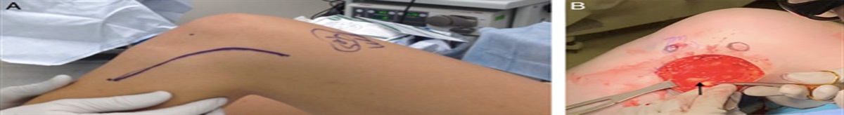 Proximal tibiofibular joint reconstruction with biceps femoris and iliotibial band autografts with suture tape augmentation