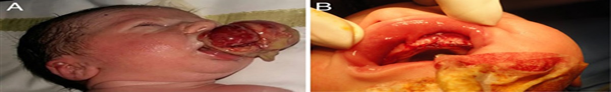 Congenital Epulis: A Rare Head And Neck Tumor in the Newborn