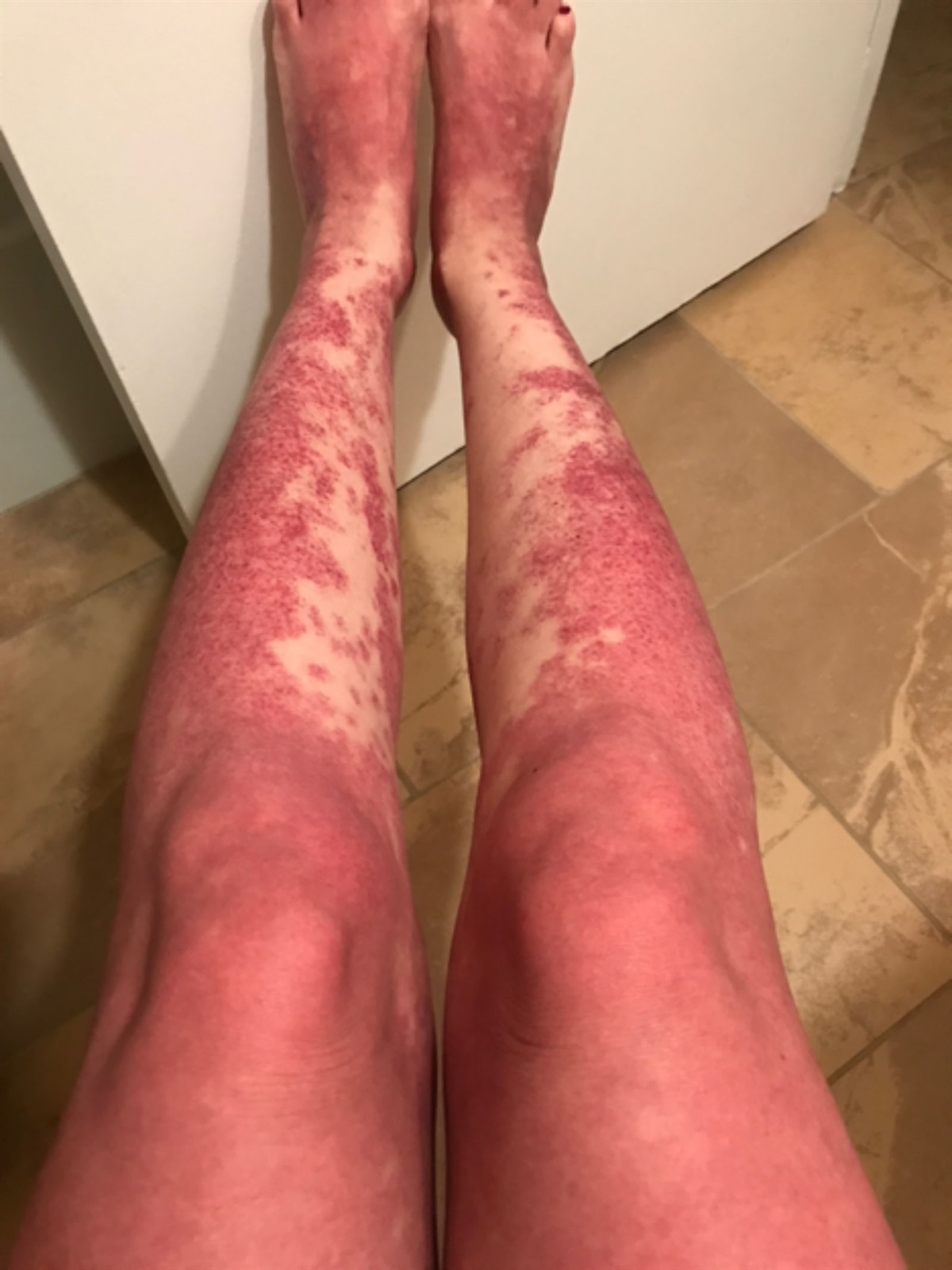 Propofol Induced Subacute Cutaneous Lupus Erythematosus: A Case Report