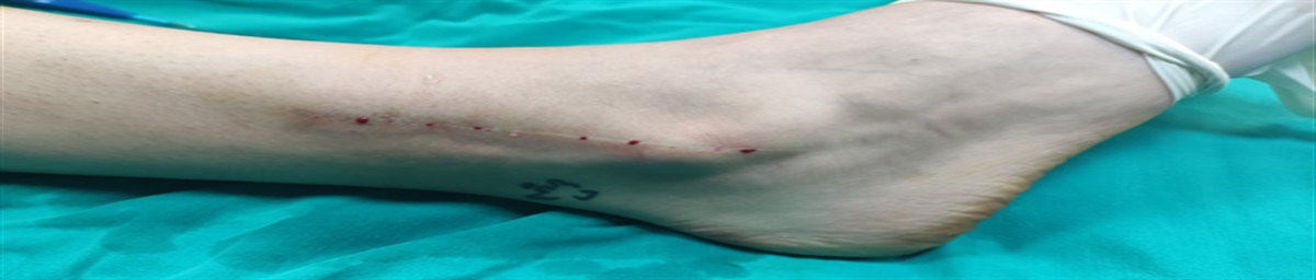 The Use of Wide-Awake Local Anesthesia No Tourniquet (WALANT) Technique for Distal Fibula Hardware Removal