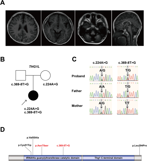 Compound heterozygous variants of THG1L result in autosomal recessive cerebellar ataxia